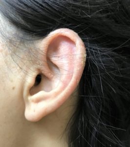 耳の湿疹　左